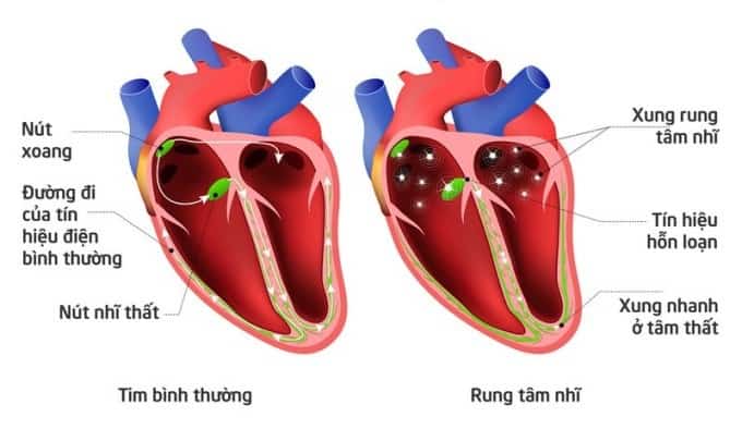 kết quả phẫu thuật mê cung