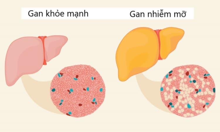 Nồng độ triglycerid cao gây gan nhiễm mỡ